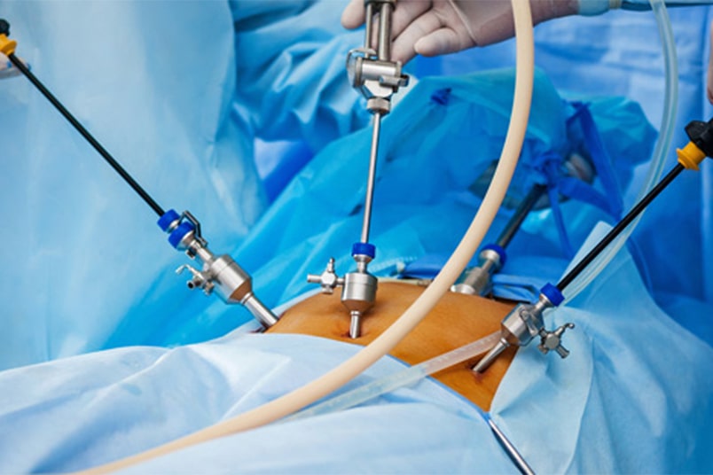 Laparoscopy